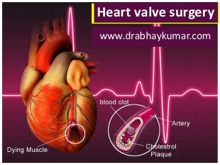Heart valve surgery 
www.drabhaykumar.com 
 
