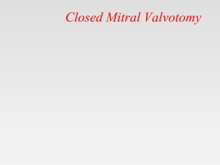 Closed Mitral Valvotomy
 