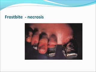 Frostbite - necrosis
 