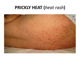 Heat Rash For Rigger Heat emergencies(Emergency Medicine) | PPTX