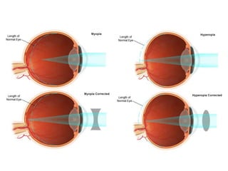 • Rays from distant objects are focused in front 
of the retina rather than on the retina. 
• The usual cause of myopia is that the eyeball 
is too long. Some forms of myopia improve 
with age. 
www.eyetalkonline.com 
 