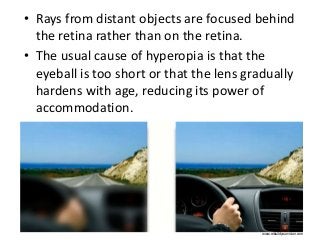 • Rays from distant objects are focused behind 
the retina rather than on the retina. 
• The usual cause of hyperopia is that the 
eyeball is too short or that the lens gradually 
hardens with age, reducing its power of 
accommodation. 
www.rebuildyourvision.com 
 