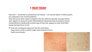 Heat Rash Management Pre hospital management of Heat stress. | PDF