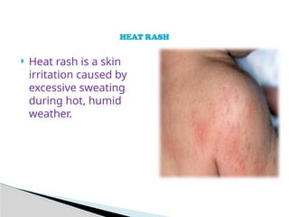 Sweat Rash Vs. Heat Rash HEAT STRESS AND PRECAUTIONARY MEASURES PPT.pptx