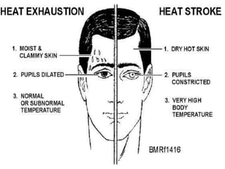 Heat stroke