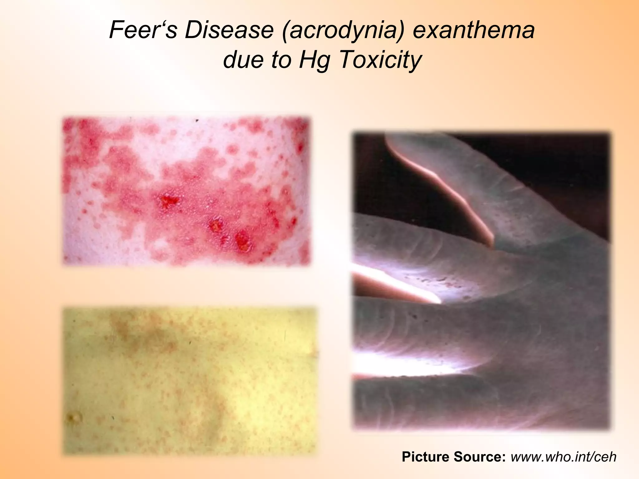 Feer‘s Disease (acrodynia) exanthema
due to Hg Toxicity
Picture Source: www.who.int/ceh
 