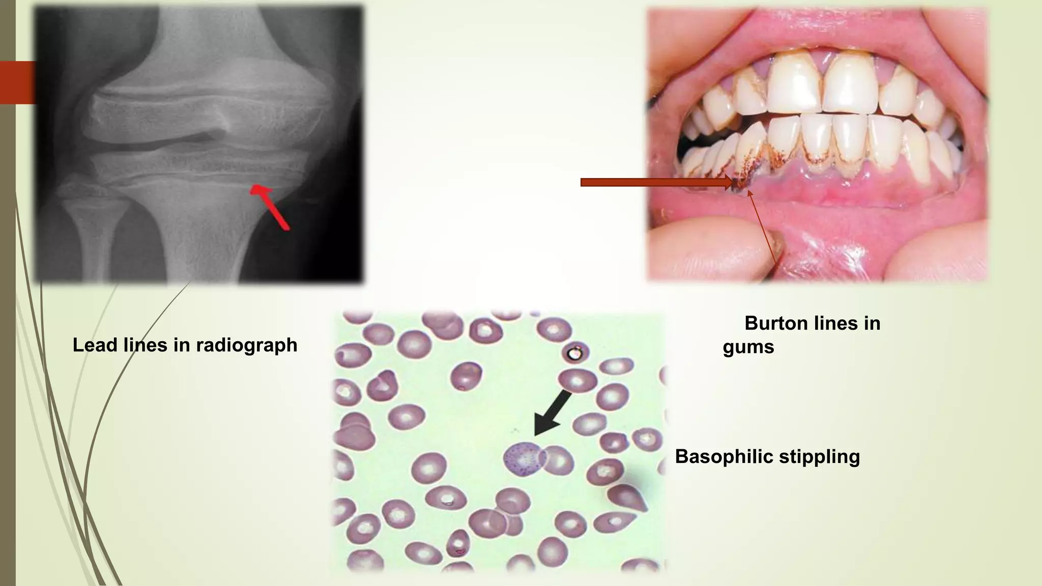 Heavy metals toxicity | PPTX
