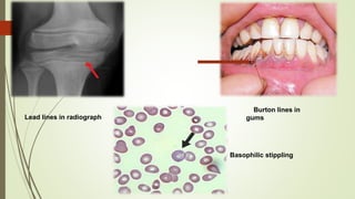 Lead lines in radiograph
Burton lines in
gums
Basophilic stippling
 