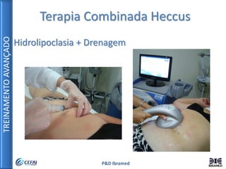 TREINAMENTOAVANÇADO
P&D Ibramed
Terapia Combinada Heccus
Hidrolipoclasia + Drenagem
 