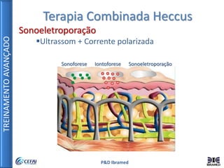 TREINAMENTOAVANÇADO
P&D Ibramed
Terapia Combinada Heccus
Sonoeletroporação
Ultrassom + Corrente polarizada
Sonoforese Iontoforese Sonoeletroporação
 