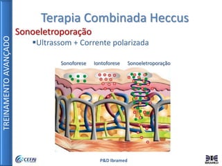 TREINAMENTOAVANÇADO
P&D Ibramed
Terapia Combinada Heccus
Sonoeletroporação
Ultrassom + Corrente polarizada
Sonoforese Iontoforese Sonoeletroporação
 