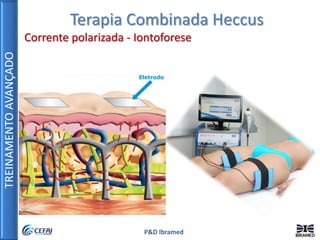 TREINAMENTOAVANÇADO
P&D Ibramed
Terapia Combinada Heccus
Corrente polarizada - Iontoforese
 