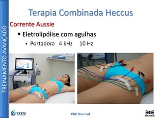 TREINAMENTOAVANÇADO
P&D Ibramed
Terapia Combinada Heccus
Corrente Aussie
 Eletrolipólise com agulhas
 Portadora 4 kHz 10 Hz
 