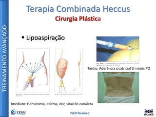 TREINAMENTOAVANÇADO
P&D Ibramed
 Lipoaspiração
Tardio: Aderência cicatricial 3 meses PO
Imediato: Hematoma, edema, dor, sinal de canaleta
Terapia Combinada Heccus
Cirurgia Plástica
 