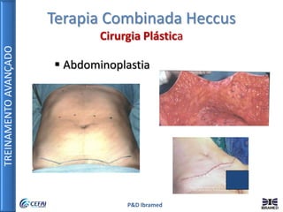 TREINAMENTOAVANÇADO
P&D Ibramed
 Abdominoplastia
Terapia Combinada Heccus
Cirurgia Plástica
 