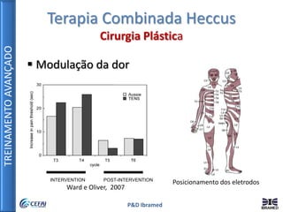 TREINAMENTOAVANÇADO
P&D Ibramed
 Modulação da dor
INTERVENTION POST-INTERVENTION
Ward e Oliver, 2007
Posicionamento dos eletrodos
Terapia Combinada Heccus
Cirurgia Plástica
 