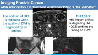 Imaging ProstateCancer
MRIProtocolsforPCaDetection/Localization:WhenisDCEindicated?
T2WI DCE
DWI
T1WI
PI-RADS 3
•Hip implant artifact
is degrading DWI
• DCE confirms the
finding on T2WI
The addition of DCE
is indicated when
the quality of DWI is
degraded by an
artifact.
 