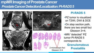 mpMRImagingofProstateCancer
ProstateCancerDetection/Localization:PI-RADS5
PI-RADS 5
•PZ tumor is visualized
on T2WI, DWI & DCE
•On step section path,
there are two small foci
Gleason 3+4;
•MRI “detected” PZ
tumor PI-RADS 5
corresponds to
Granulomatous
Prostatitis
DCE
T2WI
T2WI
2 microscopic foci
Gleason 3+4
 