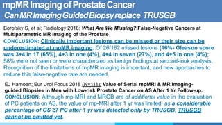 mpMRImagingofProstateCancer
CanMRImagingGuidedBiopsyreplace TRUSGB
Borofsky S, et al; Radiology 2018: What Are We Missing? False-Negative Cancers at
Multiparametric MR Imaging of the Prostate
CONCLUSION: Clinically important lesions can be missed or their size can be
underestimated at mpMR imaging. Of 26/162 missed lesions (16%- Gleason score
was 3+4 in 17 (65%), 4+3 in one (4%), 4+4 in seven (27%), and 4+5 in one (4%);
58% were not seen or were characterized as benign findings at second-look analysis.
Recognition of the limitations of mpMR imaging is important, and new approaches to
reduce this false-negative rate are needed.
EJ Hamoen; Eur Urol Focus 2018 (N=111): Value of Serial mpMRI & MR Imaging-
guided Biopsies in Men with Low-risk Prostate Cancer on AS After 1 Yr Follow-up.
CONCLUSION: Although mp-MRI and MRGB are of additional value in the evaluation
of PC patients on AS, the value of mp-MRI after 1 yr was limited, as a considerable
percentage of GS ≥7 PC after 1 yr was detected only by TRUSGB, TRUSGB
cannot be omitted yet.
 