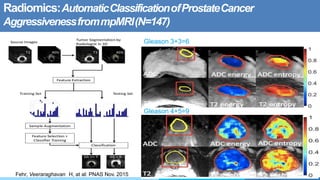 Radiomics:AutomaticClassificationofProstateCancer
AggressivenessfrommpMRI(N=147)
Gleason 3+3=6
Gleason 4+5=9
Fehr, Veeraraghavan H, at al: PNAS Nov. 2015
 