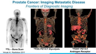 Prostate Cancer: Imaging Metastatic Disease
Frontiers of Diagnostic Imaging
18FDHT PET/CT
Androgen Receptor
18FDG PET/CT Glycolysis99Tc – Bone Scan
Hricak H.: Radiology 2011
 