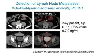 Detection of Lymph Node Metastases
Courtesy: M. Schwaiger, Technischen Universitat Munch
68Ga-PSMA(amino acid small molecule) PET/CT
68Ga-PSMA PET/CT
•54y patient, s/p
RPP, PSA-value
0.7.0 ng/ml
 