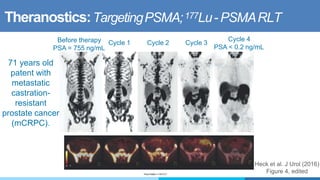 Theranostics:TargetingPSMA;177Lu- PSMARLT
68Ga-PSMA-11 PET/CT
Before therapy
PSA = 755 ng/mL
Cycle 1 Cycle 2 Cycle 3
Cycle 4
PSA < 0.2 ng/mL
Heck et al. J Urol (2016)
Figure 4, edited
71 years old
patent with
metastatic
castration-
resistant
prostate cancer
(mCRPC).
 