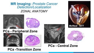 MR Imaging: Prostate Cancer
Detection/Localization
ZONAL ANATOMY
PCa - Peripheral Zone
PCa - Central Zone
PCa -Transition Zone
P
C
T
McNeal 1977
 