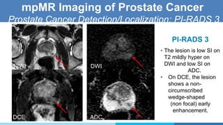 mpMR Imaging of Prostate Cancer
Prostate Cancer Detection/Localization: PI-RADS 3
PI-RADS 3
• The lesion is low SI on
T2 mildly hyper on
DWI and low SI on
ADC.
• On DCE, the lesion
shows a non-
circumscribed
wedge-shaped
(non focal) early
enhancement.
T2WI
DCE
DWI
ADC
 
