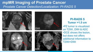 PI-RADS 5
Tumor >1.5 cm
•PZ tumor is visualized
on T2WI, DWI & ADC
•DCE shows the lesion,
but does not offers
additional information to
T2WI+DWI
T2WI
DCE
DWI
ADC
mpMR Imaging of Prostate Cancer
Prostate Cancer Detection/Localization: PI-RADS 5
 