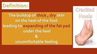 Definition:
The buildup of thick , dry skin
on the heel of the foot
leading to expanding of the fat pad
under the heel
&
uncomfortable feeling.
 