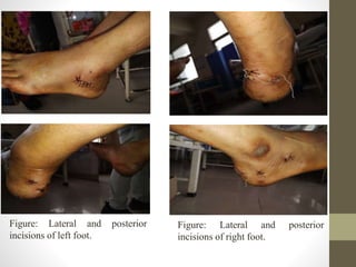 Calcaneus fracture of bilateral feet: Examination, Investigation ...