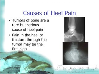 Heel Pain