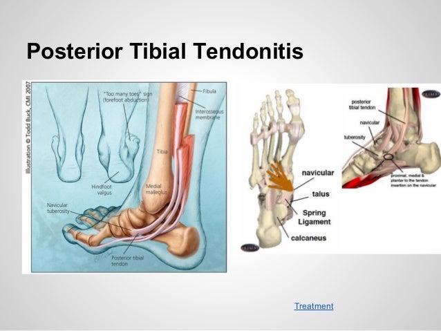 Best Shoes For Tendonitis Best Shoes For Tendonitis