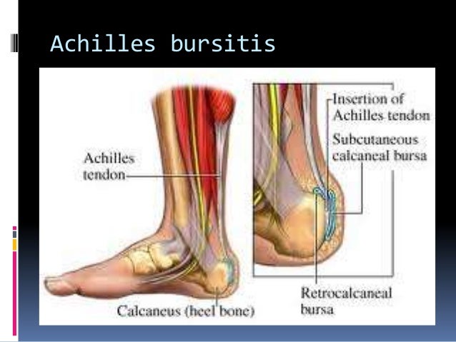 arthritis heel spur
