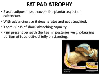 Heel pain | PPTX