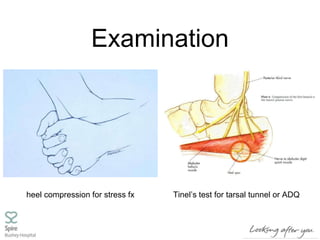 Examination
heel compression for stress fx Tinel’s test for tarsal tunnel or ADQ
 