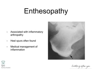 Enthesopathy
• Associated with inflammatory
arthropathy
• Heel spurs often found
• Medical management of
inflammation
 