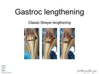 Gastroc lengthening
Classic Strayer lengthening
 
