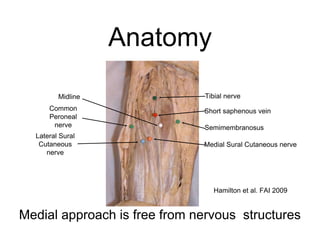 Tibial nerve
Semimembranosus
Short saphenous vein
Midline
Medial Sural Cutaneous nerve
Common
Peroneal
nerve
Lateral Sural
Cutaneous
nerve
Anatomy
Hamilton et al. FAI 2009
Medial approach is free from nervous structures
 