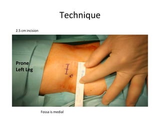 Technique
Fossa is medial
2.5 cm incision
Prone
Left Leg
 