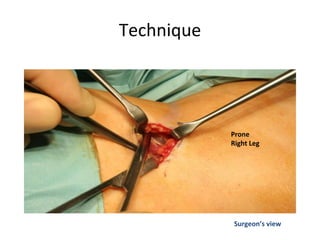 Technique
Surgeon’s view
Prone
Right Leg
 