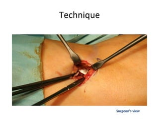 Technique
Surgeon’s view
 