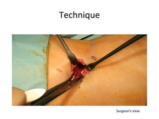 Technique
Surgeon’s view
 