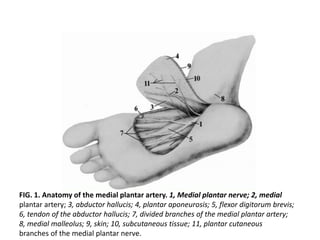 FIG. 1. Anatomy of the medial plantar artery. 1, Medial plantar nerve; 2, medial
plantar artery; 3, abductor hallucis; 4, plantar aponeurosis; 5, flexor digitorum brevis;
6, tendon of the abductor hallucis; 7, divided branches of the medial plantar artery;
8, medial malleolus; 9, skin; 10, subcutaneous tissue; 11, plantar cutaneous
branches of the medial plantar nerve.
 
