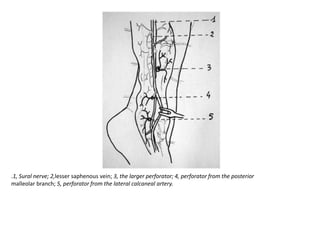 .1, Sural nerve; 2,lesser saphenous vein; 3, the larger perforator; 4, perforator from the posterior
malleolar branch; 5, perforator from the lateral calcaneal artery.
 