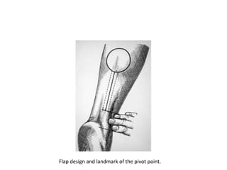 Flap design and landmark of the pivot point.
 