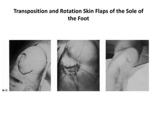 Transposition and Rotation Skin Flaps of the Sole of
the Foot
 