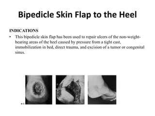 Bipedicle Skin Flap to the Heel
INDICATIONS
• This bipedicle skin flap has been used to repair ulcers of the non-weight-
bearing areas of the heel caused by pressure from a tight cast,
immobilization in bed, direct trauma, and excision of a tumor or congenital
sinus.
 