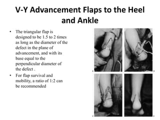 V-Y Advancement Flaps to the Heel
and Ankle
• The triangular flap is
designed to be 1.5 to 2 times
as long as the diameter of the
defect in the plane of
advancement, and with its
base equal to the
perpendicular diameter of
the defect .
• For flap survival and
mobility, a ratio of 1:2 can
be recommended
 